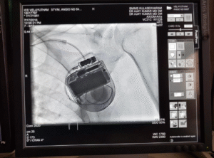 First *Implantable Cardioverter Defibrillator (ICD)* implantation done in SMIMS Cath Lab